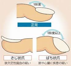 爪で簡単健康チェック フィット鍼灸整骨院 国立 聖蹟桜ヶ丘 こどもの国 国領 分倍河原