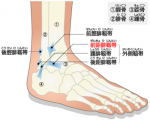 足首捻挫の種類