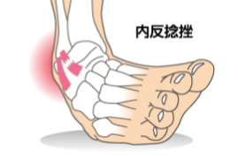 捻挫 足首 足首捻挫の重症度 セルフチェック方法